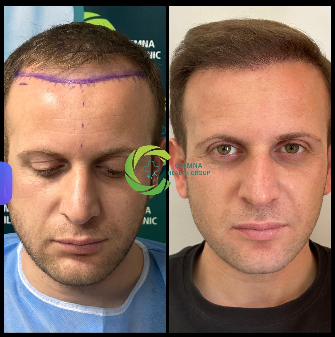 Cremna Hair Clinic patient before and after result 1